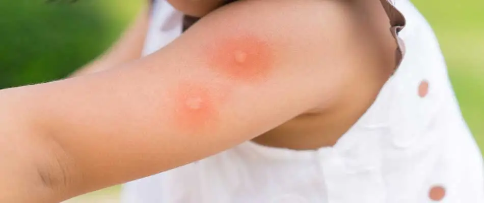 Little kid in Chesterfield, Michigan with mosquito bites on their arm.
